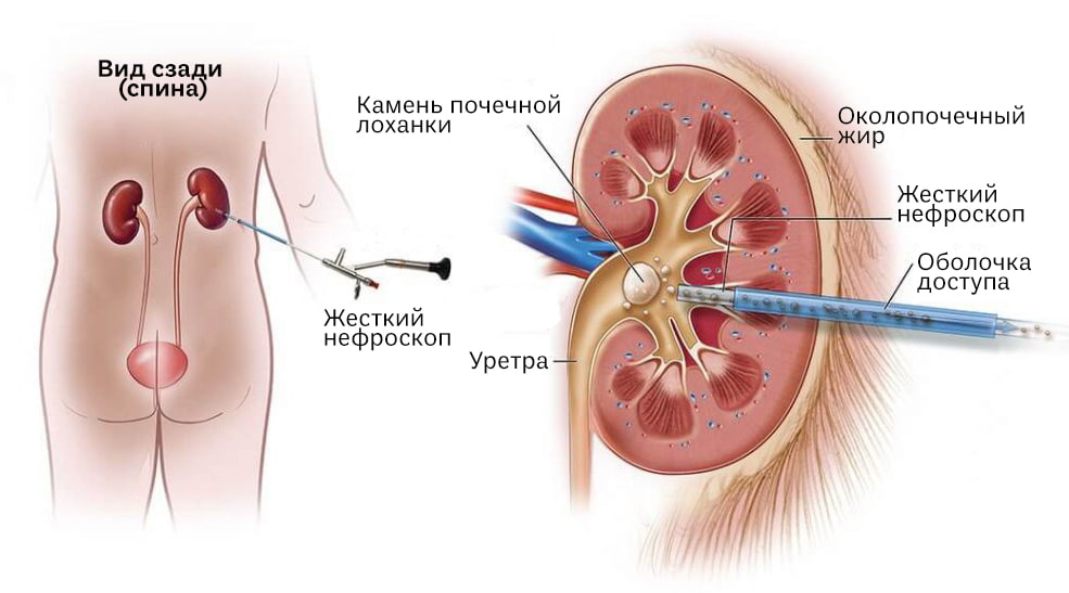 perkutannaya-nefrolitotripsiya.jpg